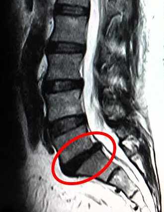 Thoát vị đĩa đệm L5 S1, gai và thoái hóa cột sống thắt lưng.